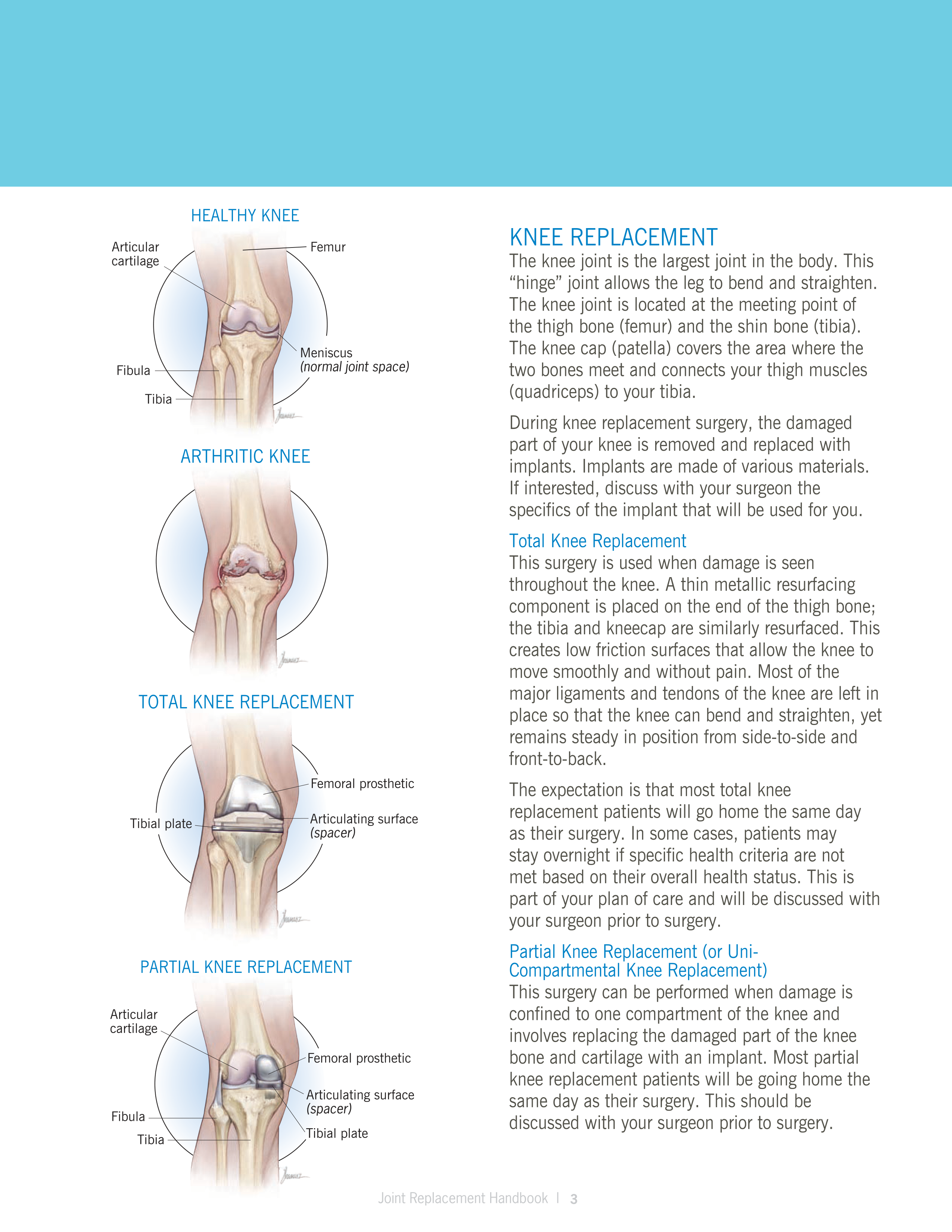 Cleveland Clinic Total Joint Replacement Guide — page 5
